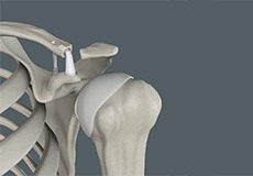 AC Joint Reconstruction
