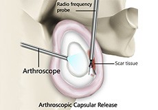 Arthroscopic Capsular Release