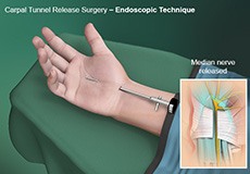 Carpal Tunnel Release Surgery
