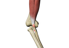 Distal Biceps Tendon Repair