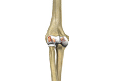 Elbow Arthritis