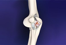 Elbow Ligament Reconstruction