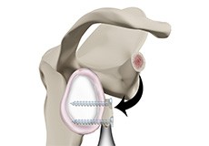 Open Latarjet Procedure