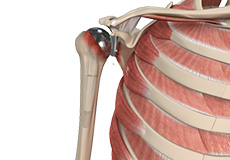 Revision Shoulder Replacement