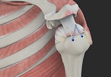 Arthroscopic Rotator Cuff Repair