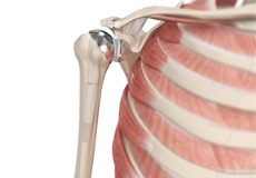 Anatomic Total Shoulder Arthroplasty