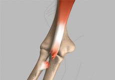 Tendon Ruptures